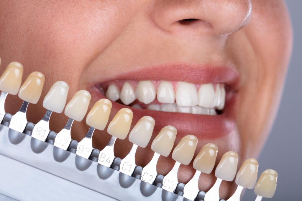 Faceta de Porcelana ou Resina: Qual é a Melhor Escolha para o Seu Sorriso?