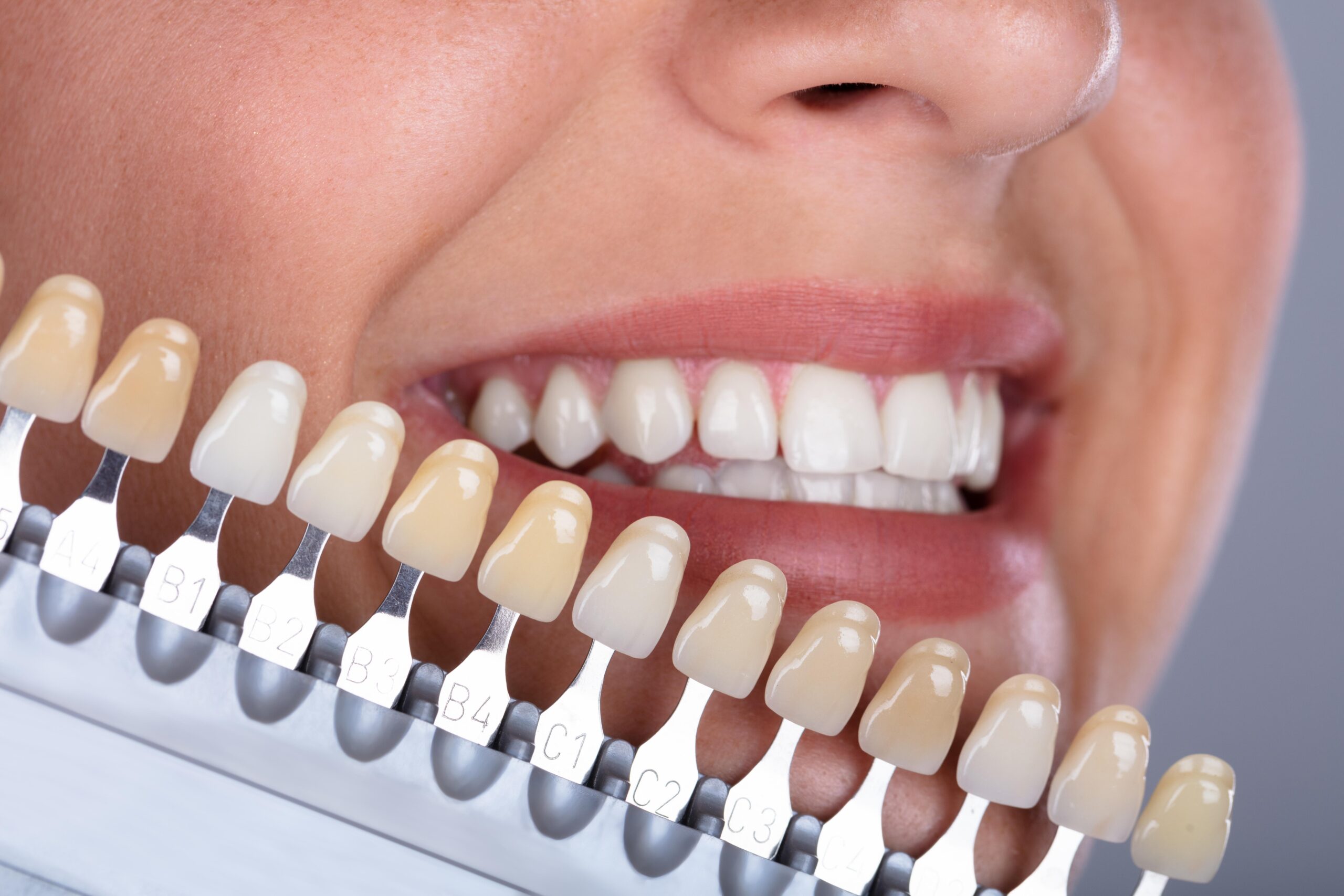Faceta de Porcelana ou Resina: Qual é a Melhor Escolha para o Seu Sorriso?
